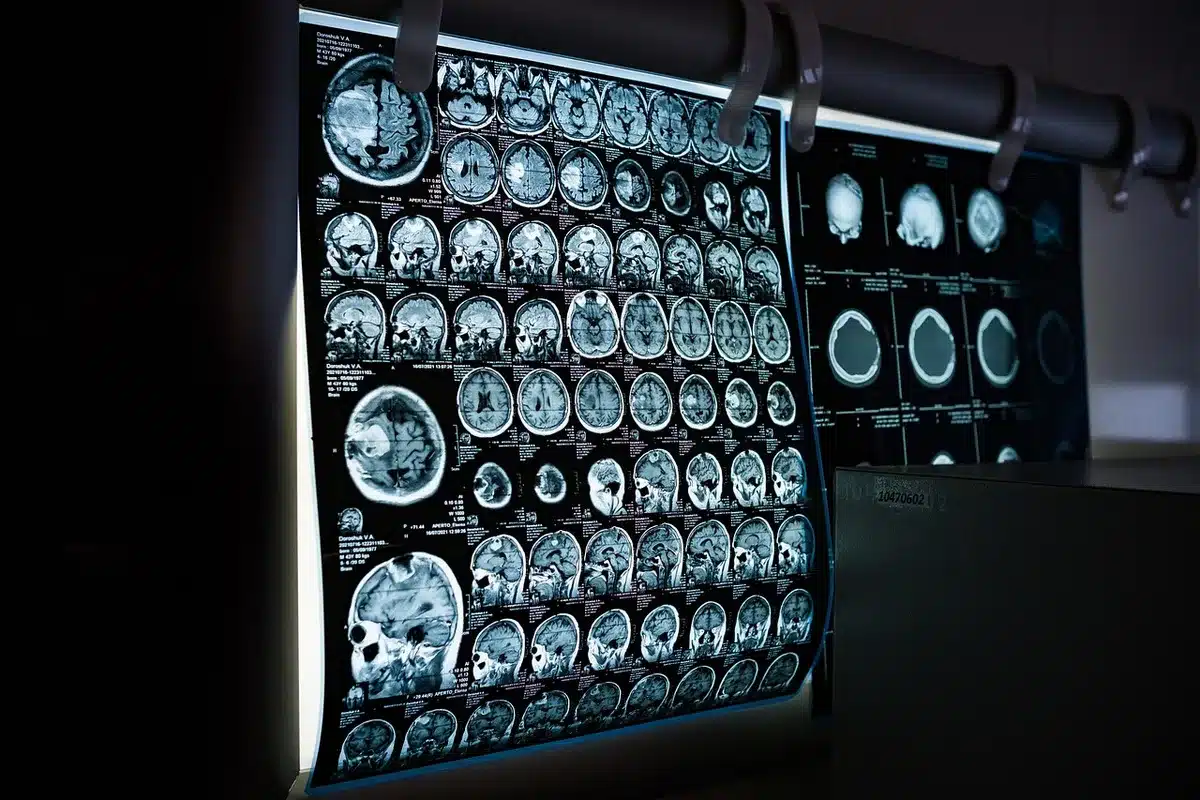 Illustration of the human brain and spinal cord showing neurological pathways